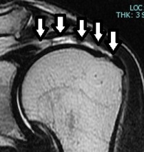 図1 左肩腱板断裂術前MRI画像(矢印：断裂部)